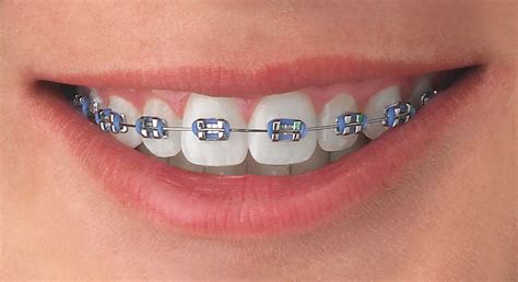 ligas metalicas brackets|colores ligas brackets.